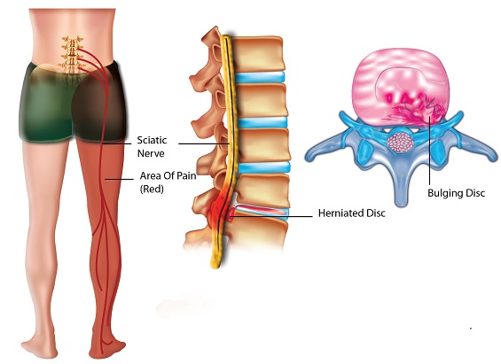 sciatica