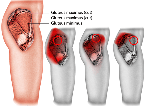 gluteal tendinopathy