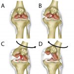 ACL (anterior cruciate ligament) injury