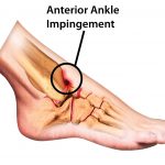 Anterior Ankle Impingement