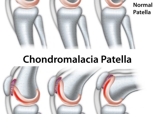 Chondromalacia Patella