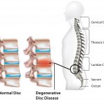 Degenerative Disc Disease