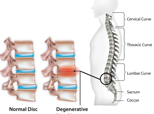 Degenerative Disc Disease-min