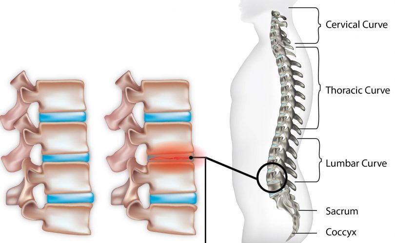Degenerative Disc Disease-min