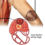 Dead Leg (Quadriceps Contusion)