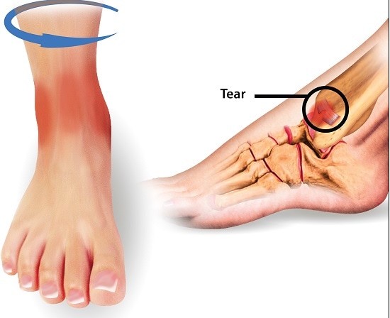 anterior talofibular ligament tear