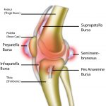 Knee Bursitis
