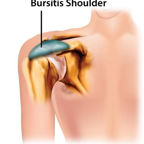shoulder bursitis