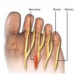 Morton’s Neuroma