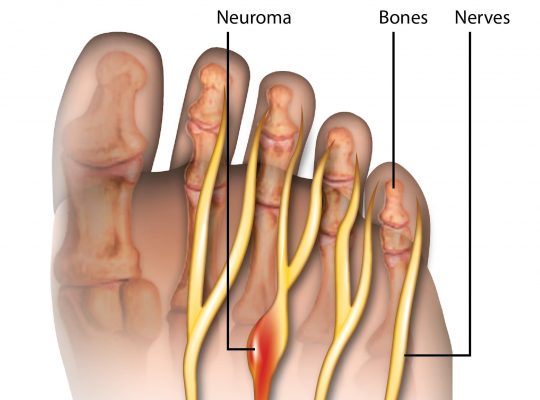 Mortons neuroma