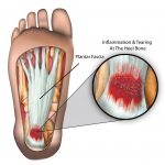 Plantar Fasciitis