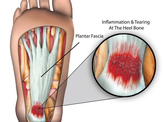 Plantar Fasciitis heel pain