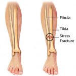 Stress Fracture