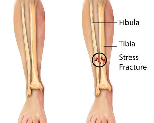 Stress Fracture