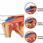 Rotator Cuff Syndrome