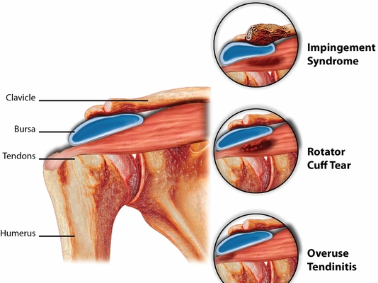 rotator cuff syndrome