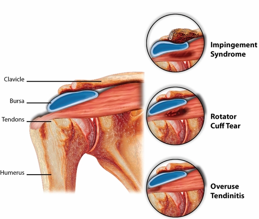 Rotator Cuff Injury - Information, Symptoms and Causes