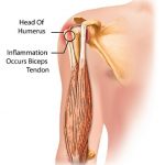 Bicep Tendonitis