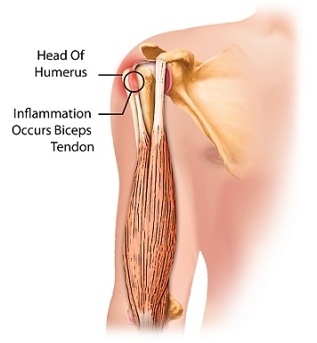 Bicep tendonitis