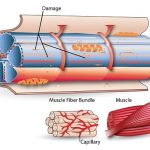 Delayed Onset Muscle Soreness (DOMS)