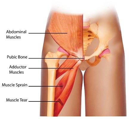 groin strain
