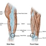 ITB (Iliotibial Band) Syndrome