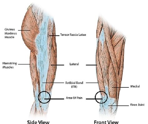 iliotibial band syndorme