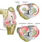 Meniscal Tears