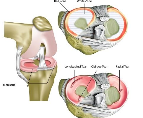 Meniscus tear