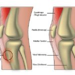 Osgood Schlatter Disease