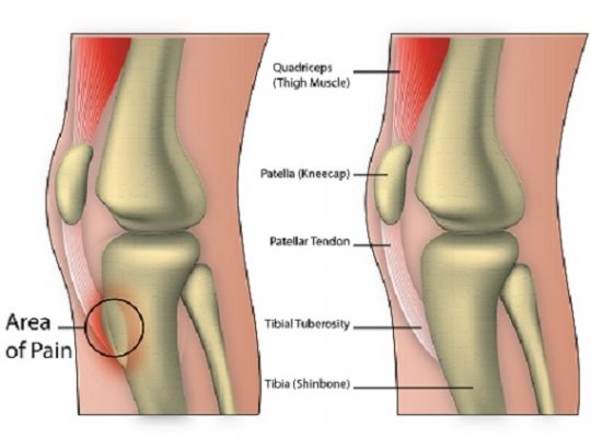 Osgood schlatters syndrome