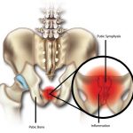 Osteitis Pubis