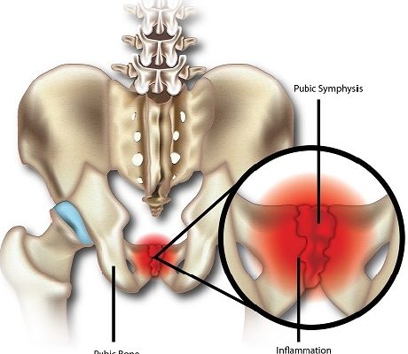 osteitis pubis