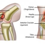 Patellofemoral Pain Syndrome