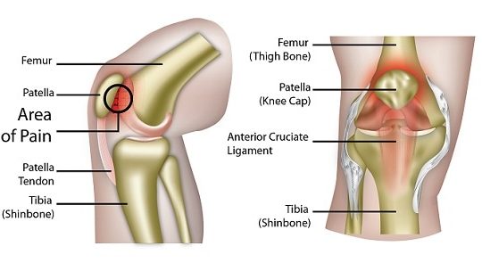 Patellofemoral pain syndrome