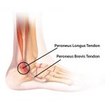 Peroneal Tendonitis