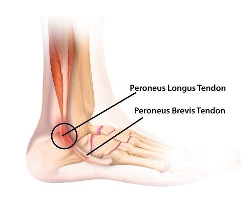 Peroneal tendonitis