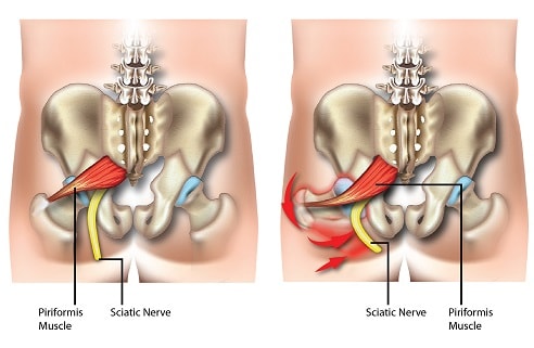 Piriformis Syndrome – Diversified Integrated Sports Clinic