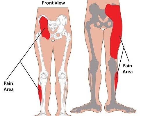 Sacroiliac joint pain