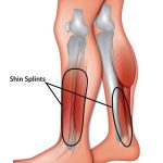 Shin Splints