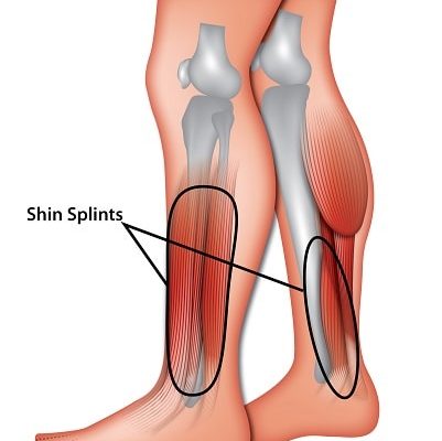 Shin Splints