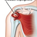 Shoulder Impingement