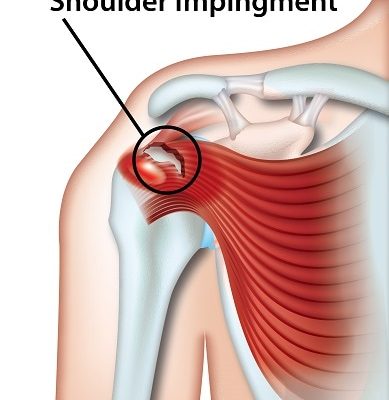 shoulder impingement