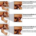 Temporomandibular Joint (TMJ) Dysfunction