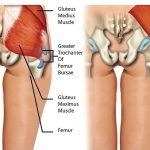 Trochanteric (Hip) Bursitis