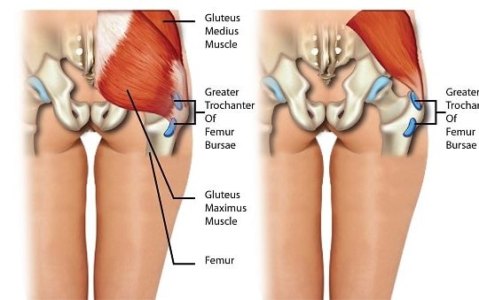 Trochanteric bursitis