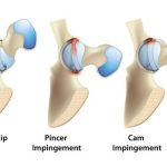 Hip Impingement