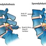 Spondylolysis and Spondylolisthesis