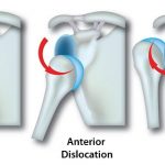 Dislocated Shoulder