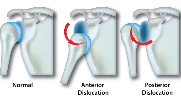 Dislocated Shoulder - Causes, Treatment and Recovery | SportNova UK